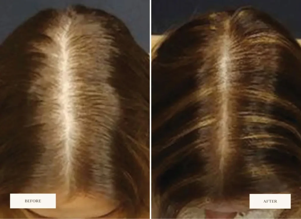 Before and after scalp treatment